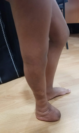 Limb Length Inequality